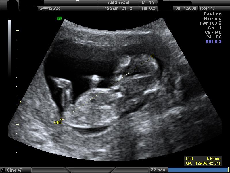 ultrasound dating scan measurements