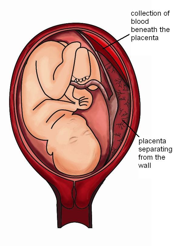 Placental Abruption Pitter Patter