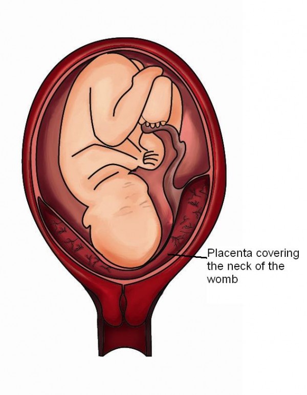 Placenta Previa Pitter Patter 